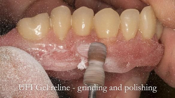 Newsletter 52 Managing Jo’s failing dentition with extractions and Mk 1/Mk 2 complete upper dentures and lower partial dentures FULL PROTOCOL