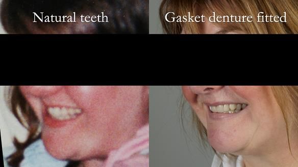 Finlay's Newsletter 58 Gasket upper partial denture for Zoe