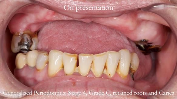 Newsletter 52 Managing Jo’s failing dentition with extractions and Mk 1/Mk 2 complete upper dentures and lower partial dentures FULL PROTOCOL