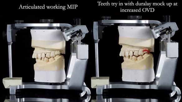 Finlay's Newsletter 64 case study - provision of a Kennedy class 2 metal based Scandinavian RPD for Ian