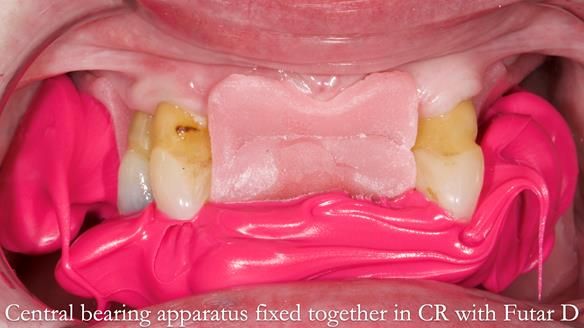 Finlay's Newsletter 59 Ultra hard partial dentures made for Gill