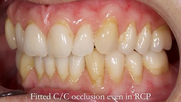 Newsletter 50 Special edition Complete Dentures FULL PROTOCOL