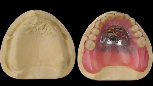Complete denture Class II div 2 deep overbite Newsletter 39