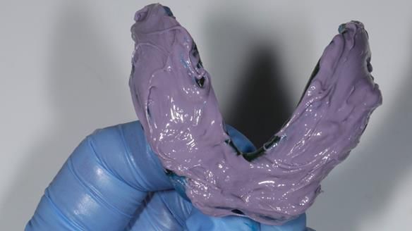 Newsletter 65 Marisa Provision of Complete Dentures on badly placed implants