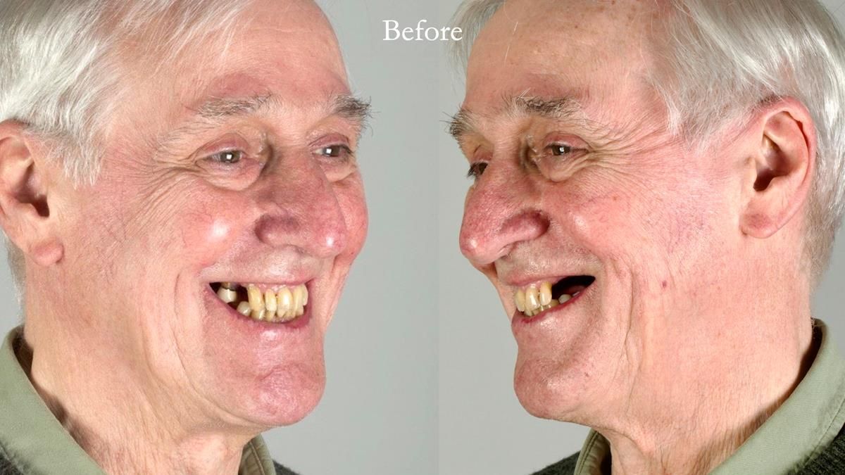 Newsletter 89 – Simon: A Challenging Kennedy Class II Division 1 Upper CoCr Partial Denture with a High Smile Line