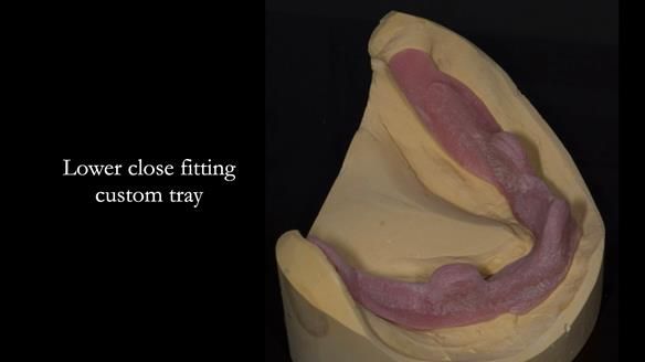 Newsletter 75: Marion’s case - Step-by-step complete denture workflow