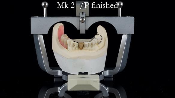 Newsletter 54 case presentation upper complete denture and lower Scandinavian designed hygienic partial denture for David