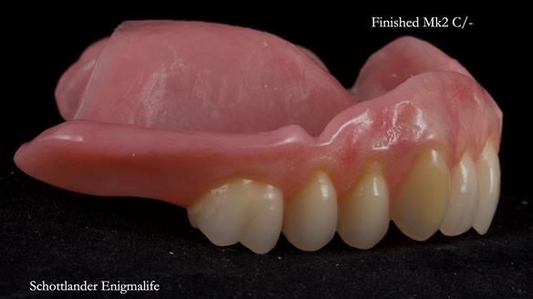Newsletter 77: Jeremy’s case – immediate complete upper denture