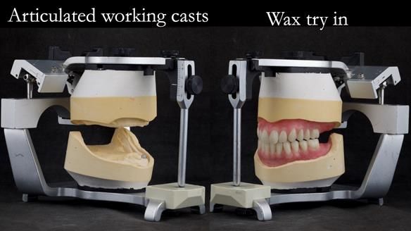 Managing poor implant positioning with complete dentures and Locator attachments - full protocol Newsletter 41