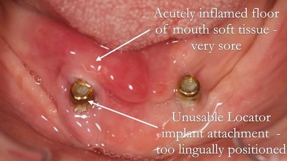 Managing poor implant positioning with complete dentures and Locator attachments - full protocol Newsletter 41