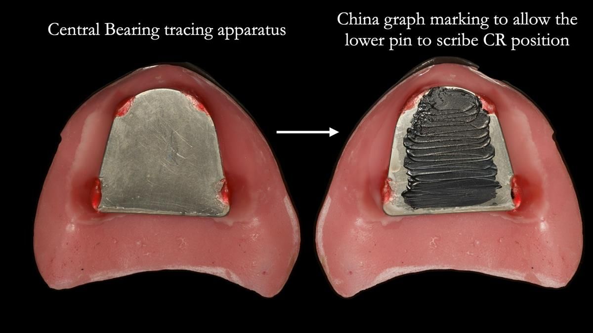 Newsletter 87 – Father Peter: A Partial Denture that needed Minor Miracle