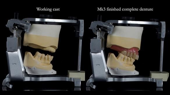 Newsletter 77: Jeremy’s case – immediate complete upper denture