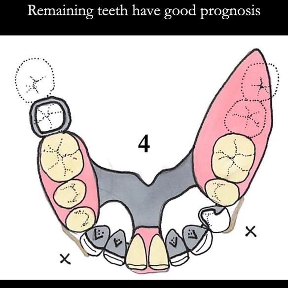 Universal Scandinavian partial denture designs