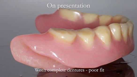 Newsletter 57 showcases the making and fitting process of implant-supported complete dentures for Alisdair