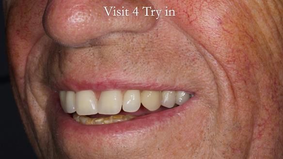 Newsletter 54 case presentation upper complete denture and lower Scandinavian designed hygienic partial denture for David