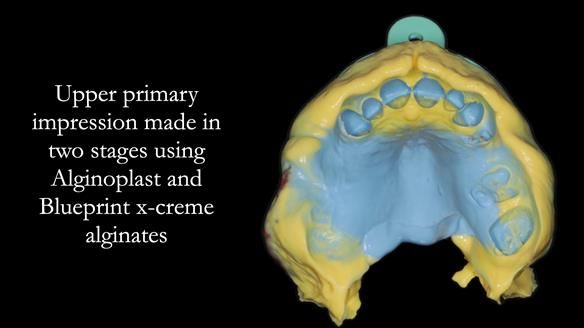 Finlay's Newsletter 60 Sylvia's upper Kennedy Class 2 Mod 1 metal based upper RPD