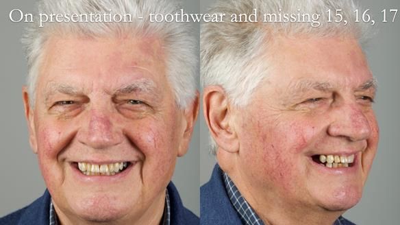 Finlay's Newsletter 64 case study - provision of a Kennedy class 2 metal based Scandinavian RPD for Ian