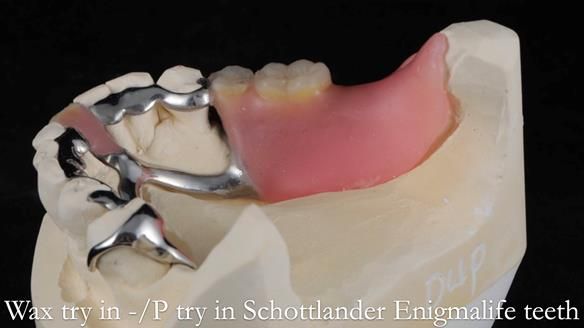 Newsletter 54 case presentation upper complete denture and lower Scandinavian designed hygienic partial denture for David