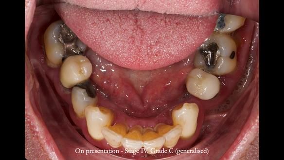 Newsletter 77: Jeremy’s case – immediate complete upper denture