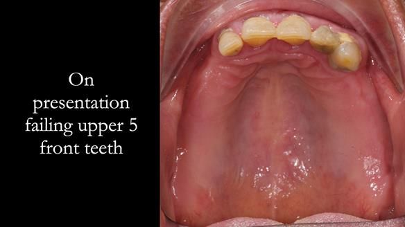 Finlay's Newsletter 62 provision of extractions and metal based complete dentures for Rafique