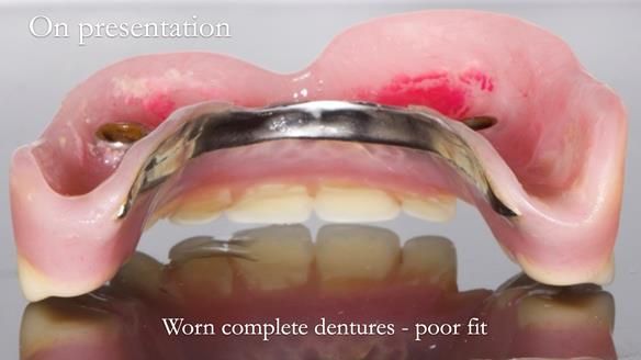Newsletter 57 showcases the making and fitting process of implant-supported complete dentures for Alisdair