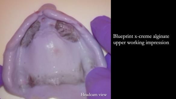 Newsletter 82 Mary - A complete upper and a one-tooth gasket denture