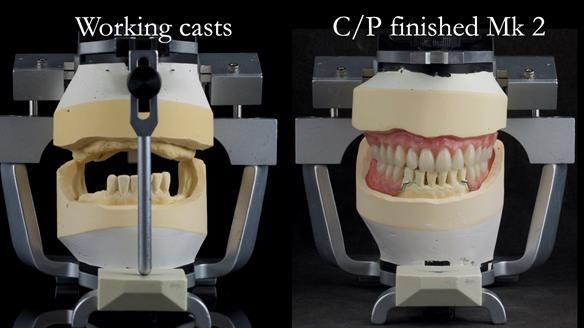 Newsletter 52 Managing Jo’s failing dentition with extractions and Mk 1/Mk 2 complete upper dentures and lower partial dentures FULL PROTOCOL