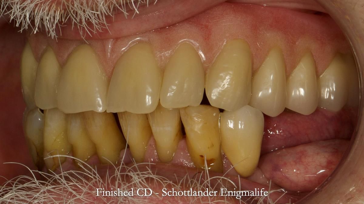 Newsletter 87 – Father Peter: A Partial Denture that needed Minor Miracle