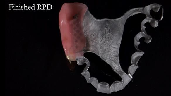 Finlay's Newsletter 64 case study - provision of a Kennedy class 2 metal based Scandinavian RPD for Ian