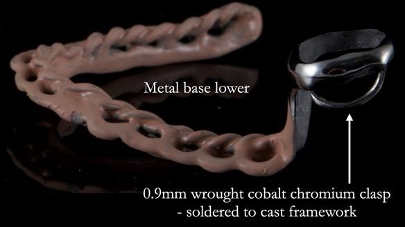 Finlay's Newsletter 59 Ultra hard partial dentures made for Gill