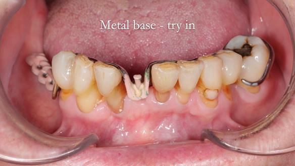 Newsletter 54 case presentation upper complete denture and lower Scandinavian designed hygienic partial denture for David