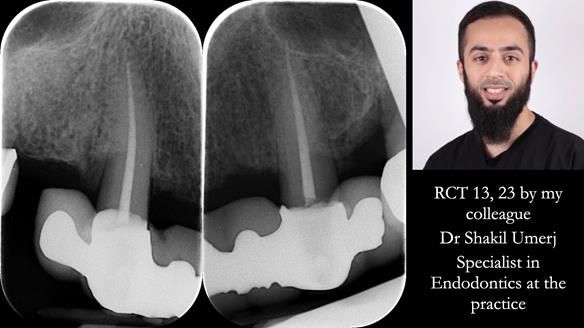 Newsletter 77: Jeremy’s case – immediate complete upper denture