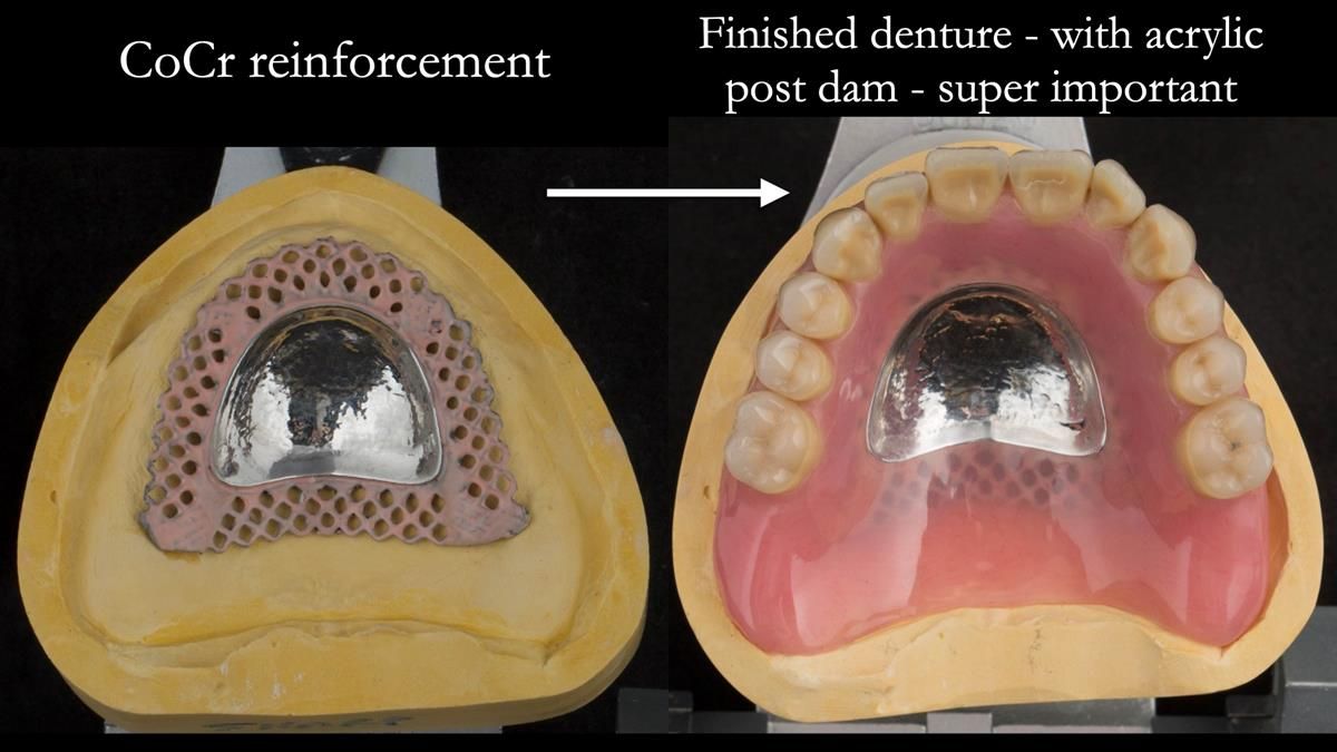 Newsletter 87 – Father Peter: A Partial Denture that needed Minor Miracle