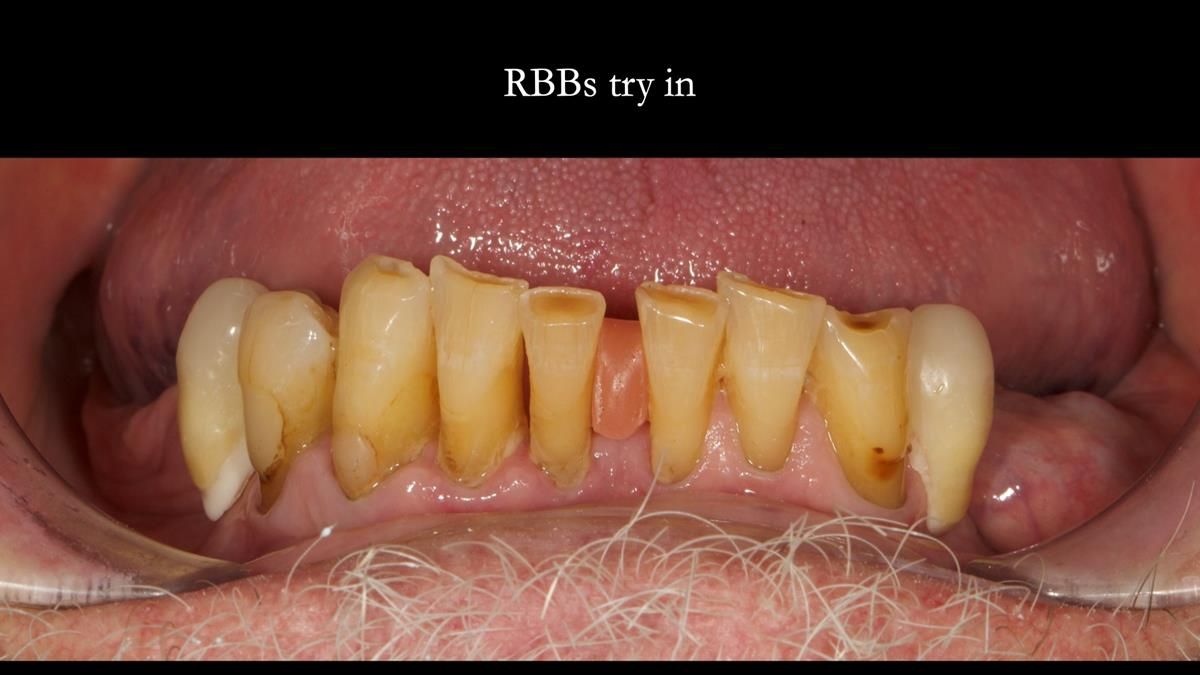 Newsletter 87 – Father Peter: A Partial Denture that needed Minor Miracle