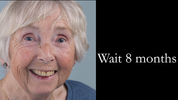 Figure 56 The patient is in a stable holding position for the next 8 months whilst further resorption occurs