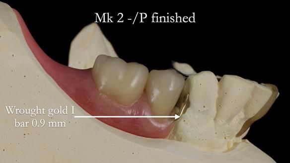 Newsletter 54 case presentation upper complete denture and lower Scandinavian designed hygienic partial denture for David