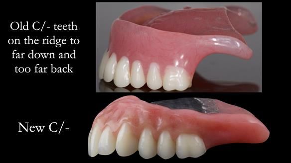 Managing poor implant positioning with complete dentures and Locator attachments - full protocol Newsletter 41