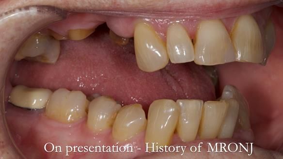 Finlay's Newsletter 60 Sylvia's upper Kennedy Class 2 Mod 1 metal based upper RPD