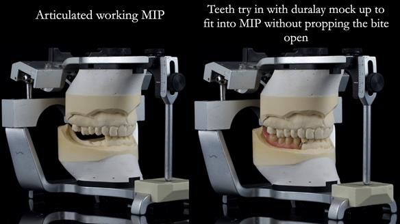 Finlay's Newsletter 61 provision of a lower unilateral free end saddle metal based partial denture for Joyce