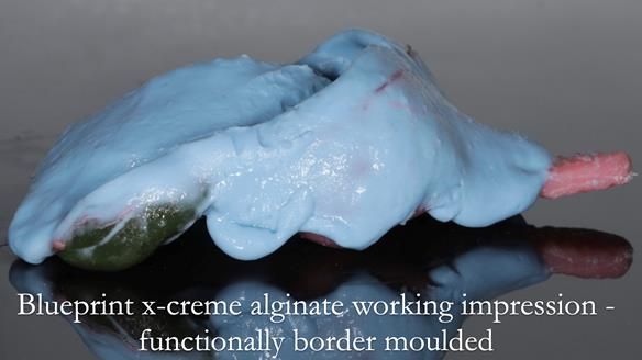 Finlay's Newsletter 59 Ultra hard partial dentures made for Gill