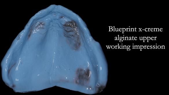 Newsletter 80 - Gordon’s dentures: the one case in 1,000 where my technique failed