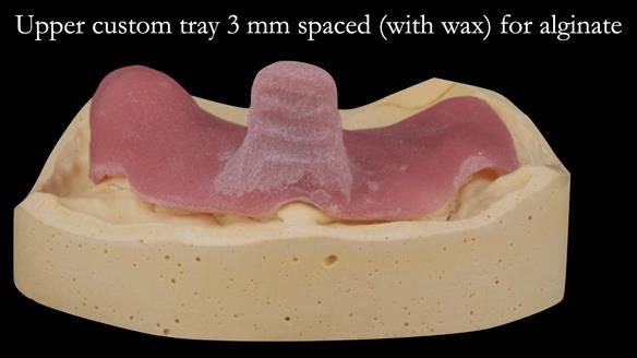 Solving Linda’s Failed “All on 4” implant bridges - full protocol Newsletter 42