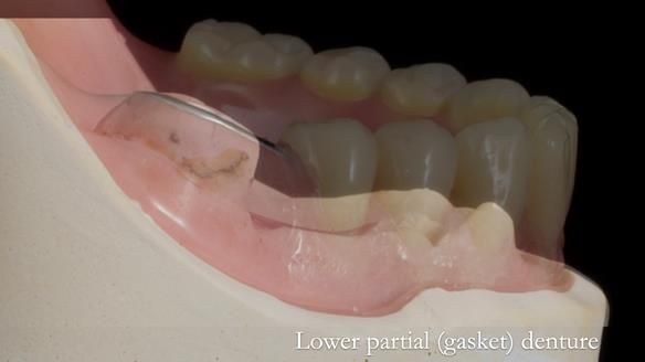 Newsletter 82 Mary - A complete upper and a one-tooth gasket denture