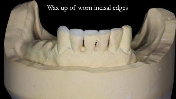Newsletter 52 Managing Jo’s failing dentition with extractions and Mk 1/Mk 2 complete upper dentures and lower partial dentures FULL PROTOCOL