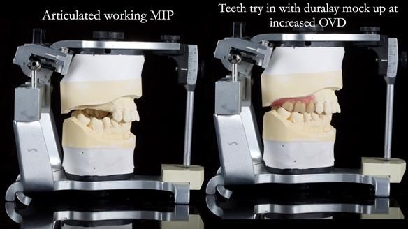 Finlay's Newsletter 64 case study - provision of a Kennedy class 2 metal based Scandinavian RPD for Ian