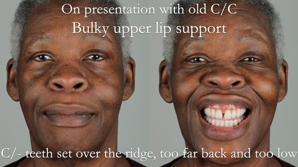 Newsletter 53 showing the making and fitting of ultra life-like dentures for Valena