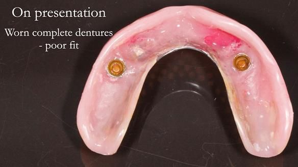 Newsletter 57 showcases the making and fitting process of implant-supported complete dentures for Alisdair