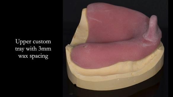 Newsletter 75: Marion’s case - Step-by-step complete denture workflow