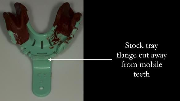 Finlay's Case Study Newsletter 40 - Immediate Mk 1 RPD to Definitive Mk 2 RPD - full protocol