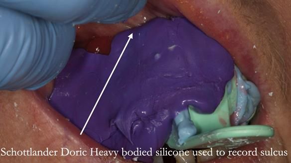 Finlay's Case Study Newsletter 40 - Immediate Mk 1 RPD to Definitive Mk 2 RPD - full protocol